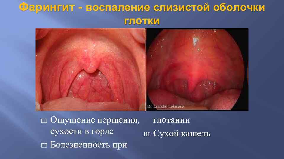 Фарингит - воспаление слизистой оболочки глотки Ш Ш Ощущение першения, сухости в горле Болезненность