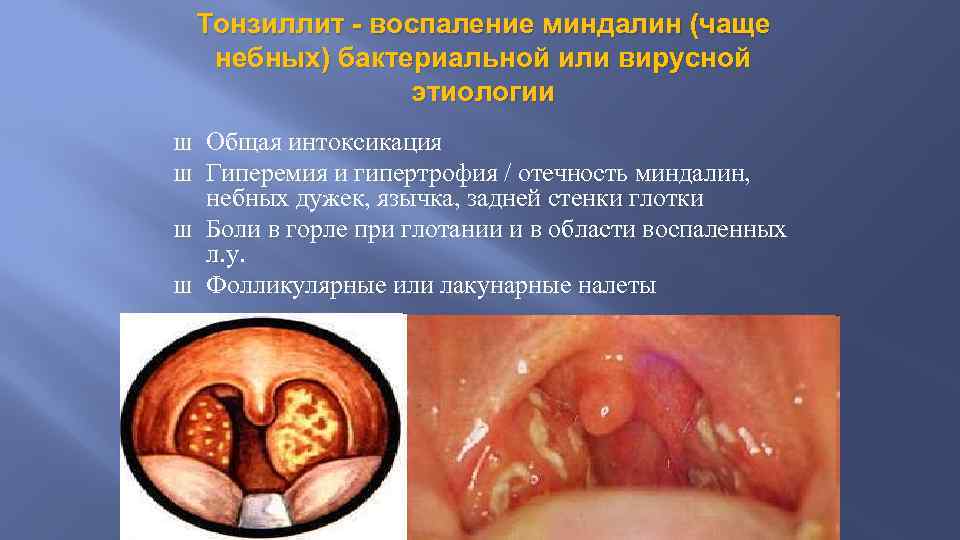 Тонзиллит - воспаление миндалин (чаще небных) бактериальной или вирусной этиологии Ш Ш Общая интоксикация
