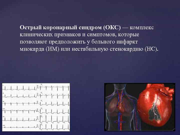 Острый коронарный синдром (ОКС) — комплекс клинических признаков и симптомов, которые позволяют предположить у