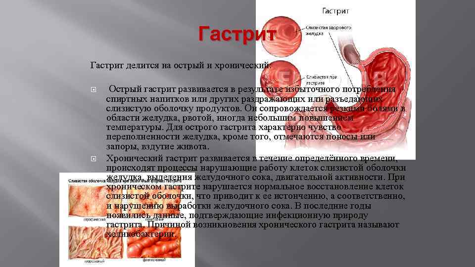 Гастрит делится на острый и хронический: Острый гастрит развивается в результате избыточного потребления спиртных