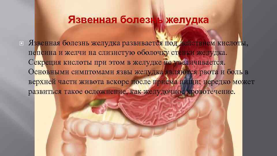 Язвенная болезнь желудка развивается под действием кислоты, пепсина и желчи на слизистую оболочку стенки