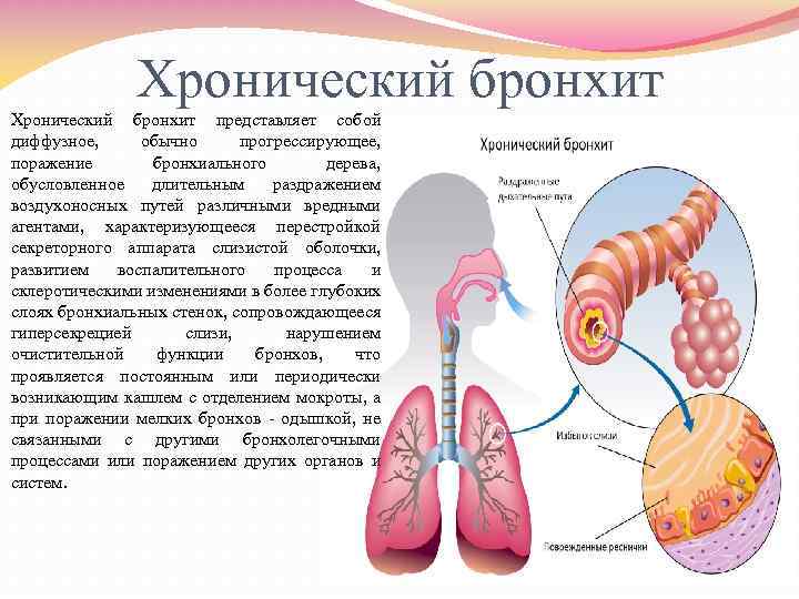 Хронический бронхит представляет собой диффузное, обычно прогрессирующее, поражение бронхиального дерева, обусловленное длительным раздражением воздухоносных