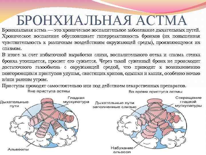 БРОНХИАЛЬНАЯ АСТМА Бронхиальная астма — это хроническое воспалительное заболевание дыхательных путей. Хроническое воспаление обусловливает