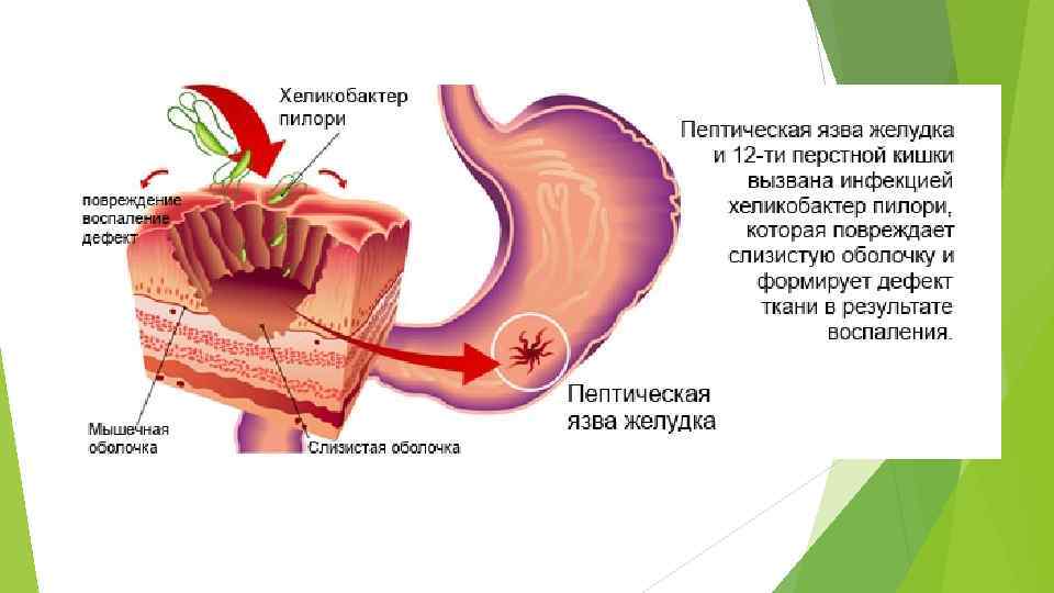 Язвенная болезнь желудка патофизиология презентация