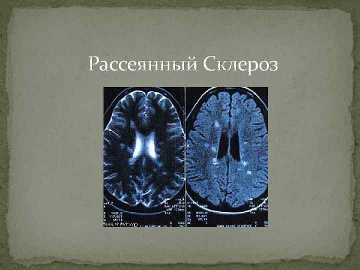 Рассеянный Склероз 