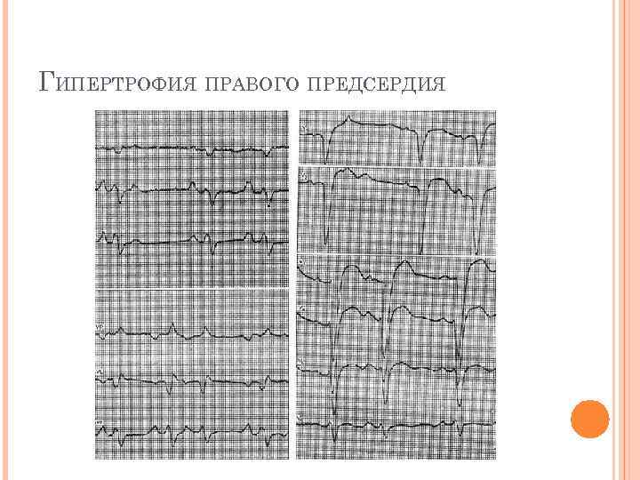 ГИПЕРТРОФИЯ ПРАВОГО ПРЕДСЕРДИЯ 