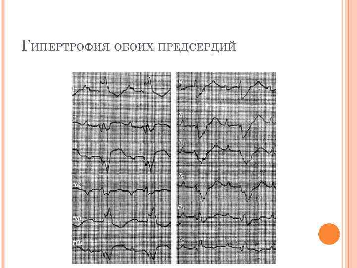 ГИПЕРТРОФИЯ ОБОИХ ПРЕДСЕРДИЙ 