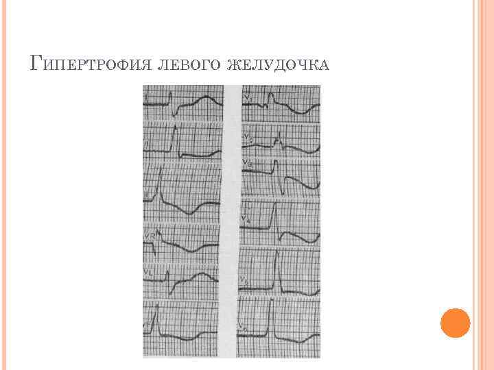 ГИПЕРТРОФИЯ ЛЕВОГО ЖЕЛУДОЧКА 