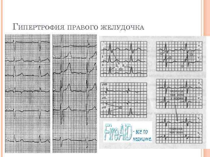 ГИПЕРТРОФИЯ ПРАВОГО ЖЕЛУДОЧКА 