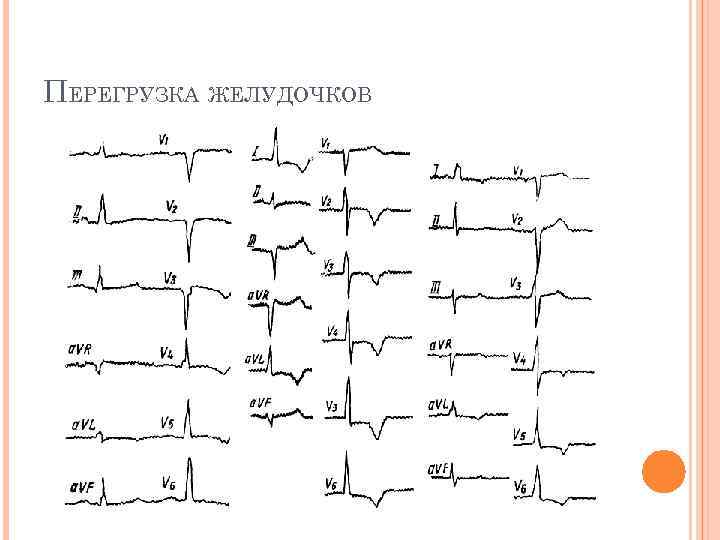 ПЕРЕГРУЗКА ЖЕЛУДОЧКОВ 