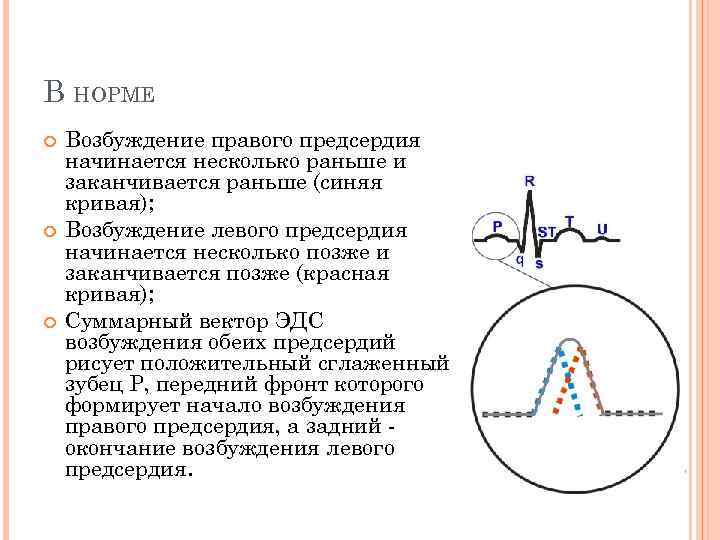 В НОРМЕ Возбуждение правого предсердия начинается несколько раньше и заканчивается раньше (синяя кривая); Возбуждение