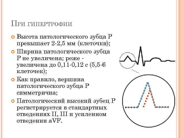 ПРИ ГИПЕРТРОФИИ Высота патологического зубца P превышает 2 -2, 5 мм (клеточки); Ширина патологического
