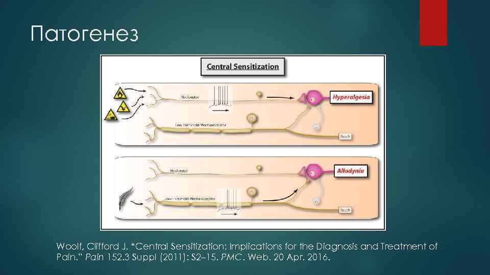 Патогенез Woolf, Clifford J. “Central Sensitization: Implications for the Diagnosis and Treatment of Pain.