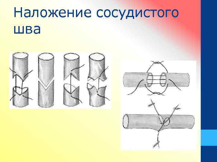 Наложение сосудистого шва 