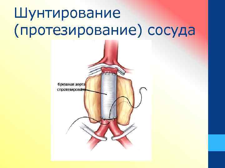 Шунтирование (протезирование) сосуда 