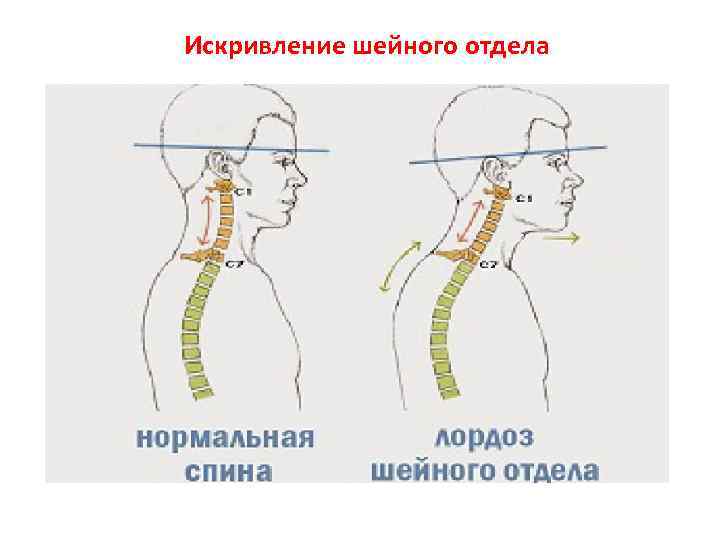 Искривление шейного отдела 