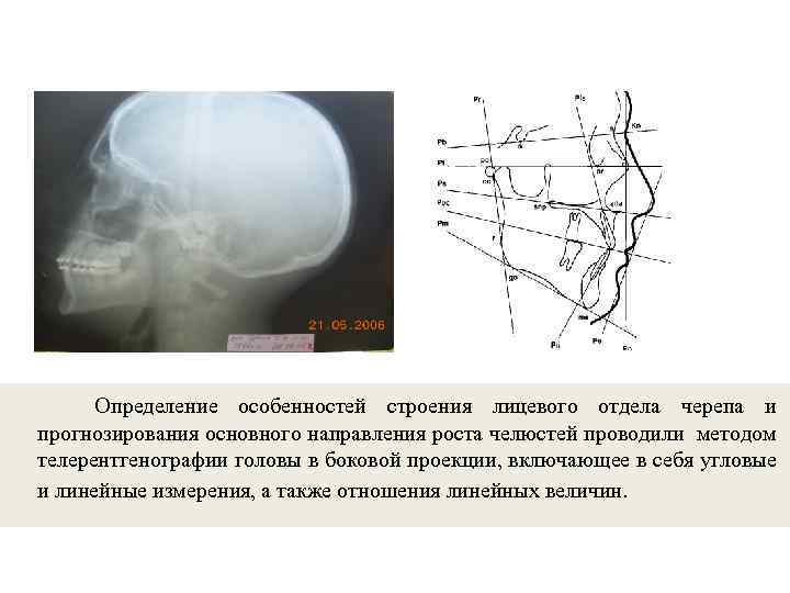 Определение особенностей строения лицевого отдела черепа и прогнозирования основного направления роста челюстей проводили методом