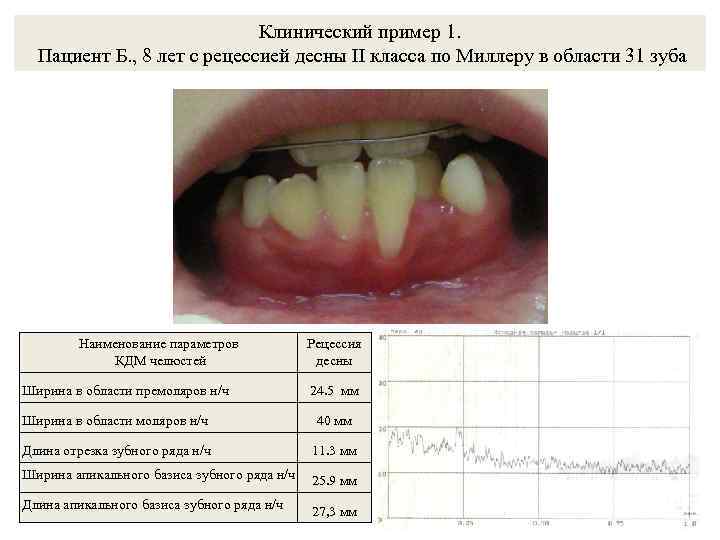 Клинический пример 1. Пациент Б. , 8 лет с рецессией десны II класса по