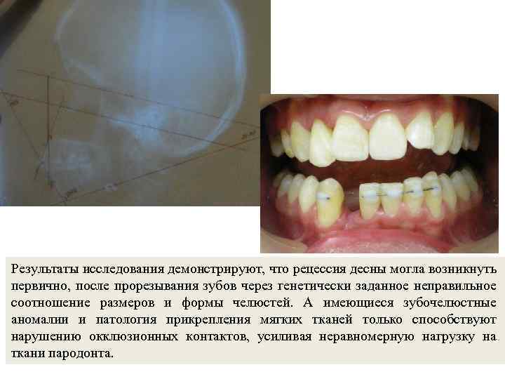 Результаты исследования демонстрируют, что рецессия десны могла возникнуть первично, после прорезывания зубов через генетически