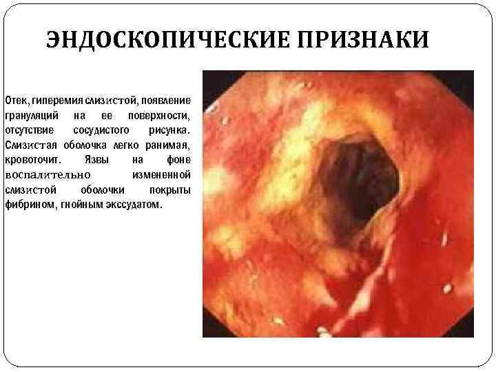 ЭНДОСКОПИЧЕСКИЕ ПРИЗНАКИ Отек, гиперемия слизистой, появление грануляций на ее поверхности, отсутствие сосудистого рисунка. Слизистая