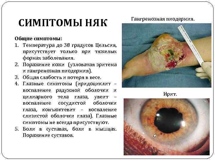 СИМПТОМЫ НЯК Общие симптомы: 1. Температура до 38 градусов Цельсия, присутствует только при тяжелых