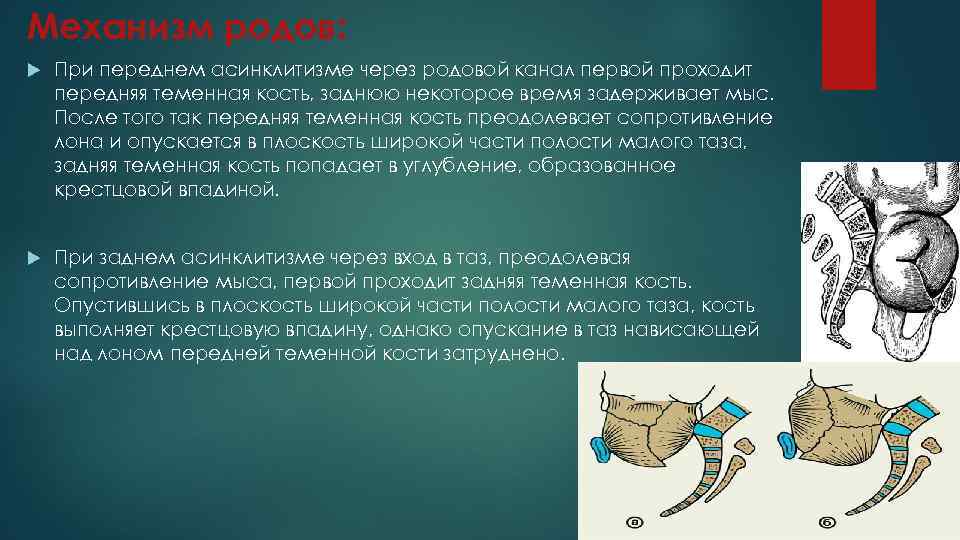 Механизм родов: При переднем асинклитизме через родовой канал первой проходит передняя теменная кость, заднюю