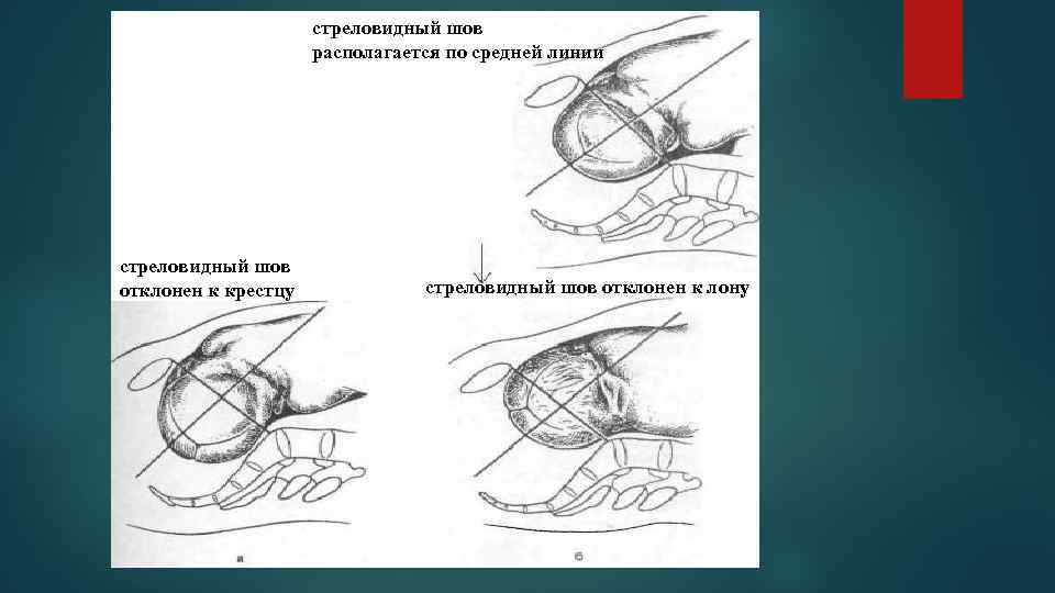 стреловидный шов располагается по средней линии стреловидный шов отклонен к крестцу стреловидный шов отклонен