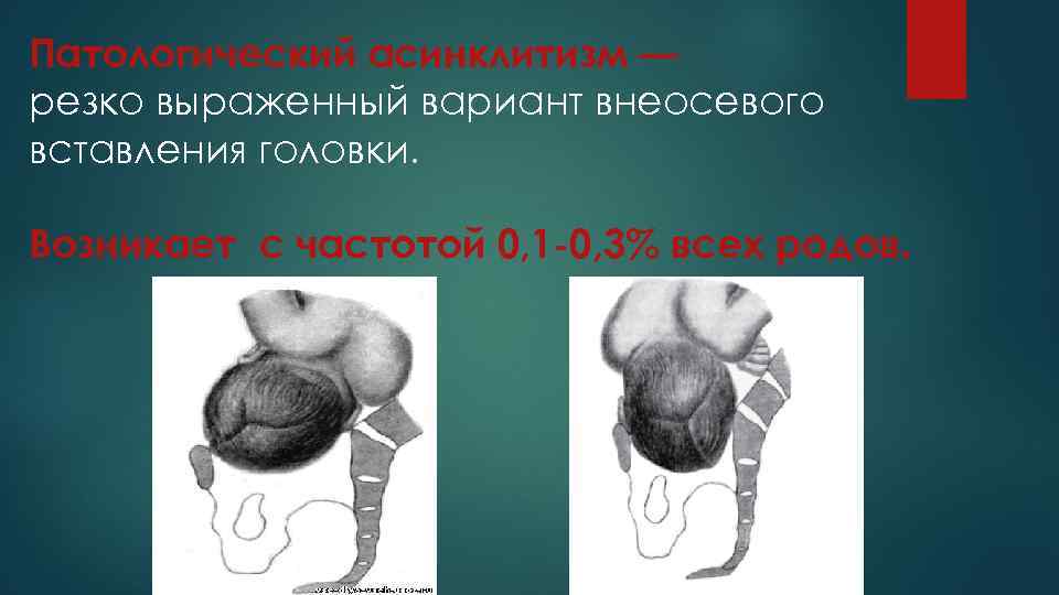 Патологический асинклитизм — резко выраженный вариант внеосевого вставления головки. Возникает с частотой 0, 1