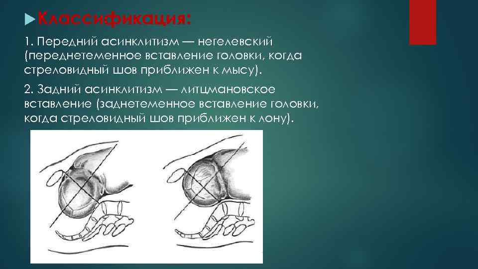  Классификация: 1. Передний асинклитизм — негелевский (переднетеменное вставление головки, когда стреловидный шов приближен