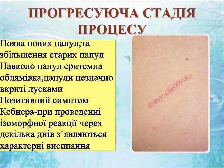 ПРОГРЕСУЮЧА СТАДІЯ ПРОЦЕСУ 