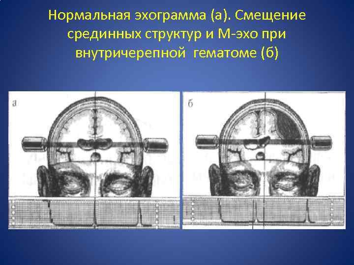 Нормальная эхограмма (а). Смещение срединных структур и М-эхо при внутричерепной гематоме (б) 