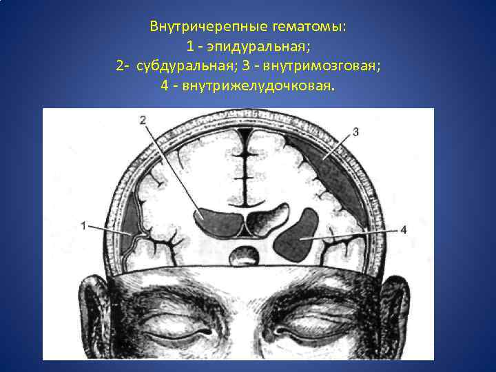 Внутричерепные гематомы: 1 - эпидуральная; 2 - субдуральная; 3 - внутримозговая; 4 - внутрижелудочковая.