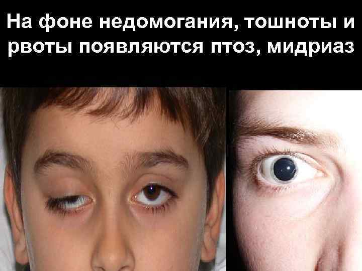На фоне недомогания, тошноты и рвоты появляются птоз, мидриаз 