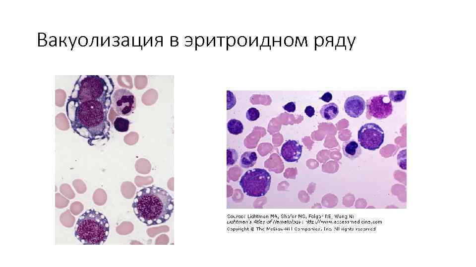 Вакуолизация в эритроидном ряду 