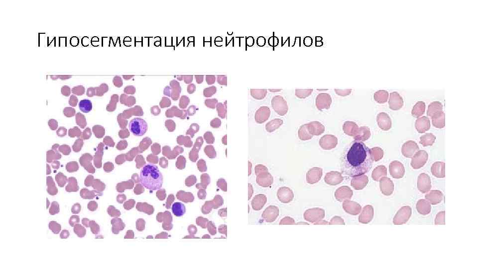 Гипосегментация нейтрофилов 