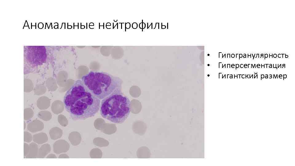 Аномальные нейтрофилы • Гипогранулярность • Гиперсегментация • Гигантский размер 