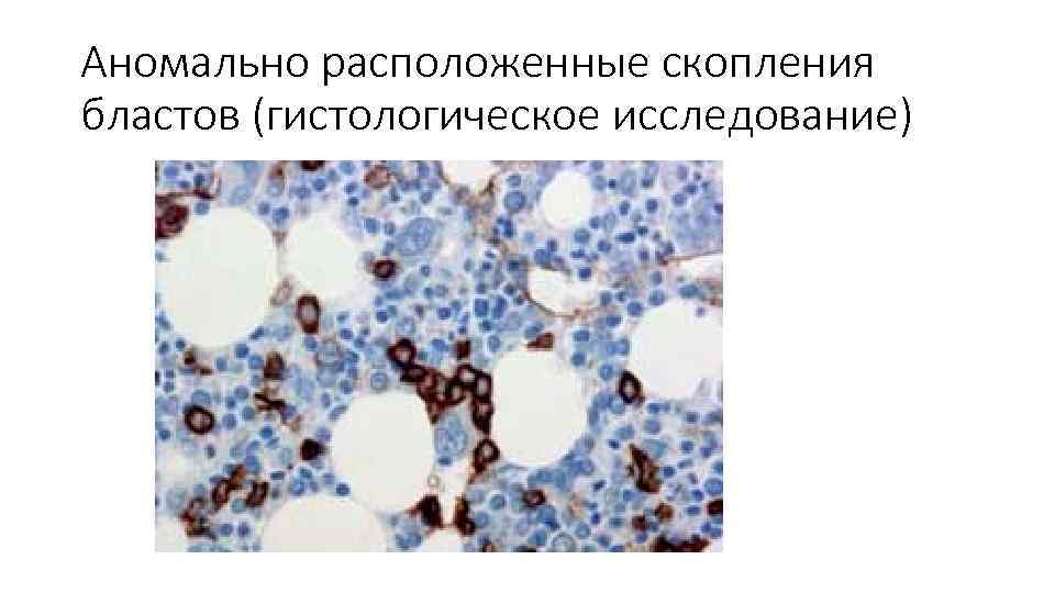 Аномально расположенные скопления бластов (гистологическое исследование) 