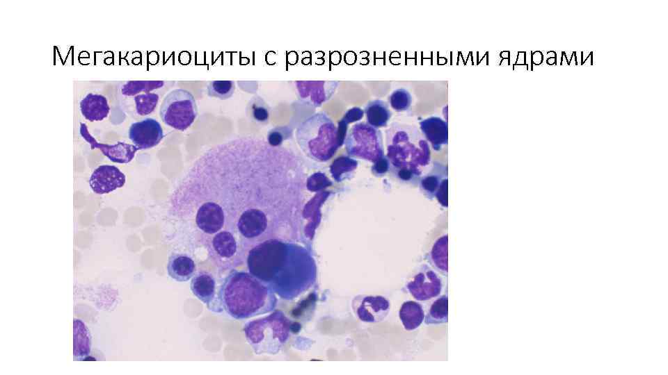 Мегакариоциты с разрозненными ядрами 