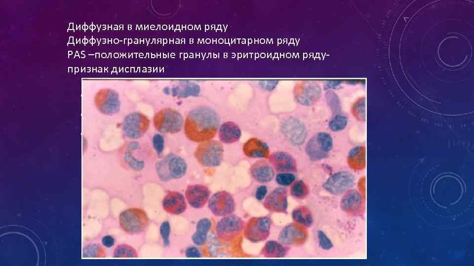 Диффузная в миелоидном ряду Диффузно-гранулярная в моноцитарном ряду PAS –положительные гранулы в эритроидном рядупризнак