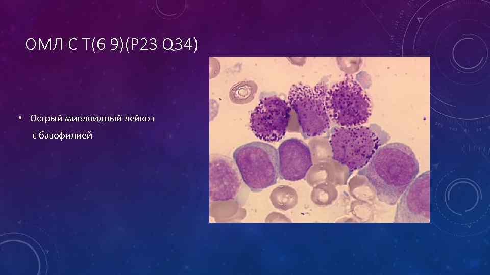 ОМЛ С T(6 9)(P 23 Q 34) • Острый миелоидный лейкоз с базофилией 