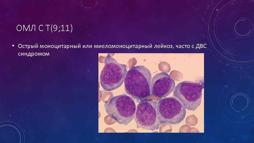 ОМЛ С T(9; 11) • Острый моноцитарный или миеломоноцитарный лейкоз, часто с ДВС синдромом