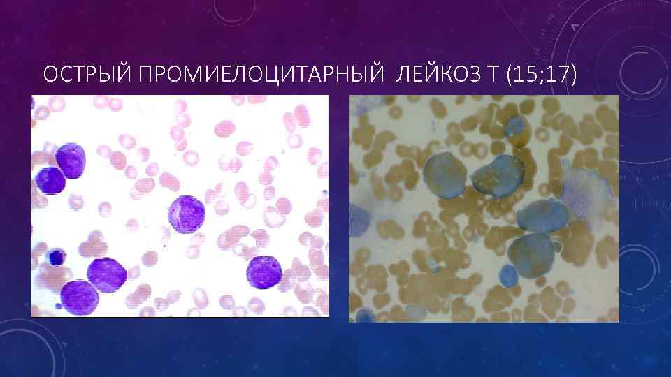 ОСТРЫЙ ПРОМИЕЛОЦИТАРНЫЙ ЛЕЙКОЗ T (15; 17) 