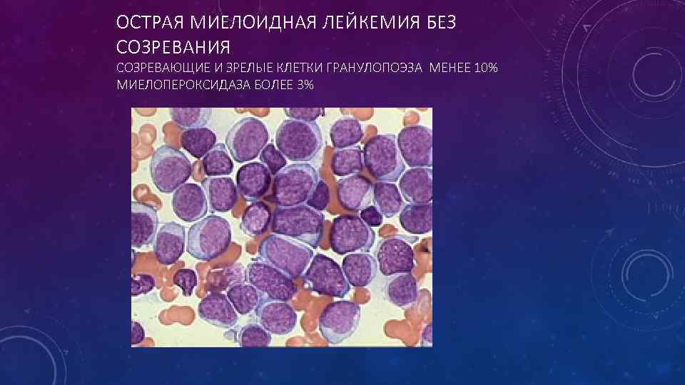 ОСТРАЯ МИЕЛОИДНАЯ ЛЕЙКЕМИЯ БЕЗ СОЗРЕВАНИЯ СОЗРЕВАЮЩИЕ И ЗРЕЛЫЕ КЛЕТКИ ГРАНУЛОПОЭЗА МЕНЕЕ 10% МИЕЛОПЕРОКСИДАЗА БОЛЕЕ