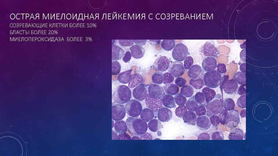 ОСТРАЯ МИЕЛОИДНАЯ ЛЕЙКЕМИЯ С СОЗРЕВАНИЕМ СОЗРЕВАЮЩИЕ КЛЕТКИ БОЛЕЕ 10% БЛАСТЫ БОЛЕЕ 20% МИЕЛОПЕРОКСИДАЗА БОЛЕЕ