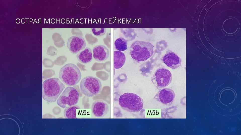 ОСТРАЯ МОНОБЛАСТНАЯ ЛЕЙКЕМИЯ 