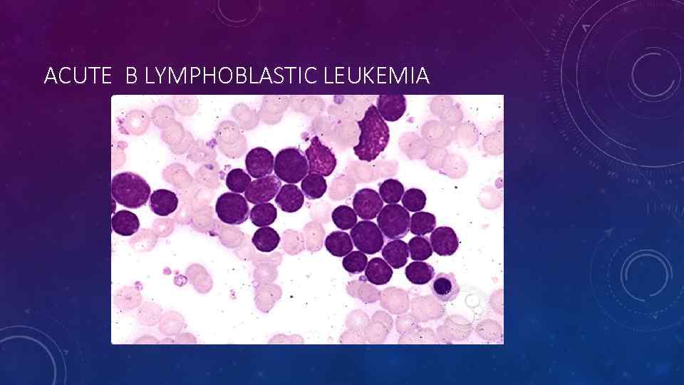 ACUTE B LYMPHOBLASTIC LEUKEMIA 