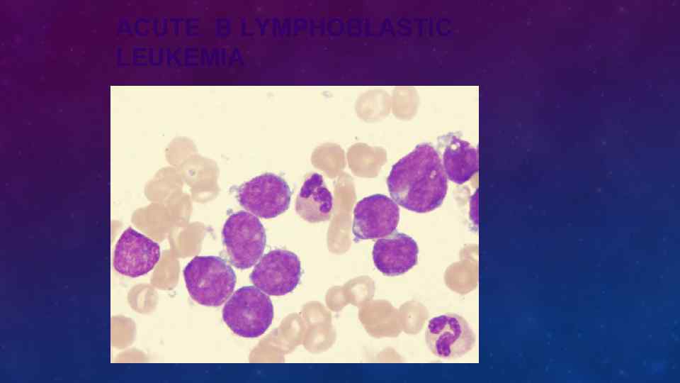 ACUTE B LYMPHOBLASTIC LEUKEMIA 