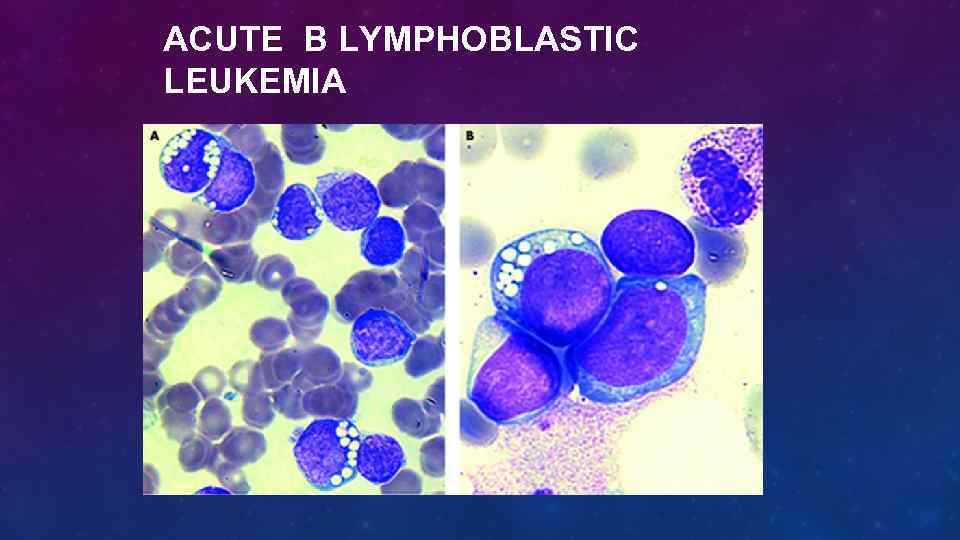 ACUTE B LYMPHOBLASTIC LEUKEMIA 