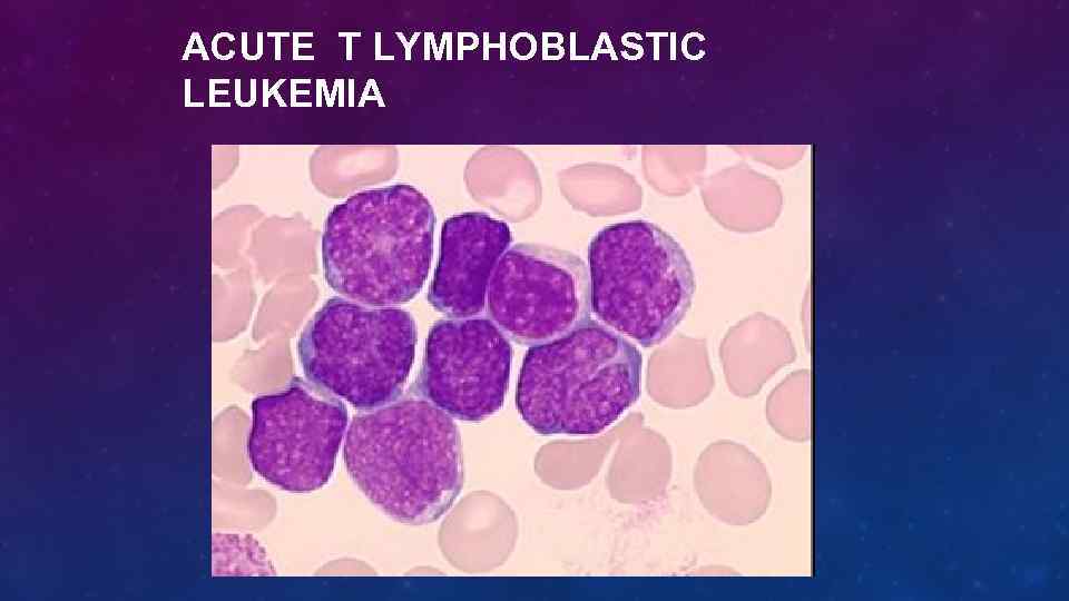 ACUTE T LYMPHOBLASTIC LEUKEMIA 