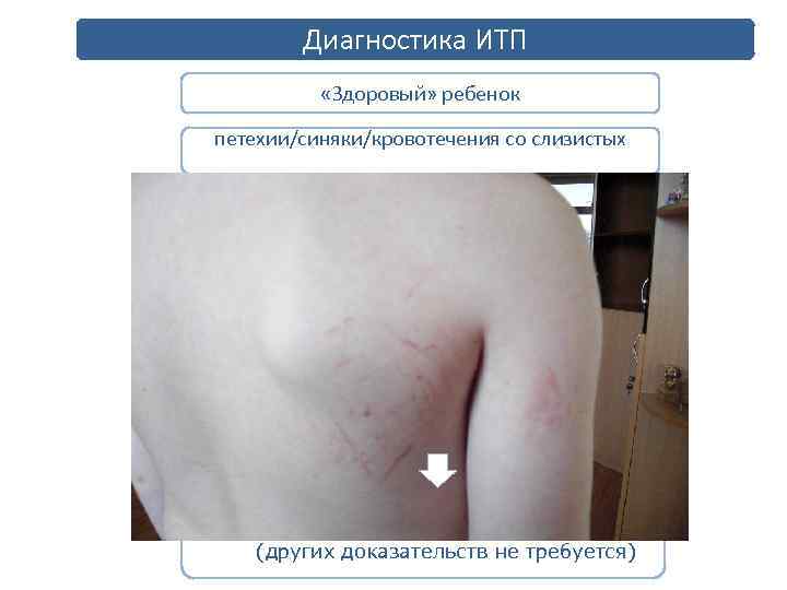 Диагностика ИТП «Здоровый» ребенок петехии/синяки/кровотечения со слизистых без семейного анамнеза кровоточивости/тромбоцитопении без нейтропении аномальной